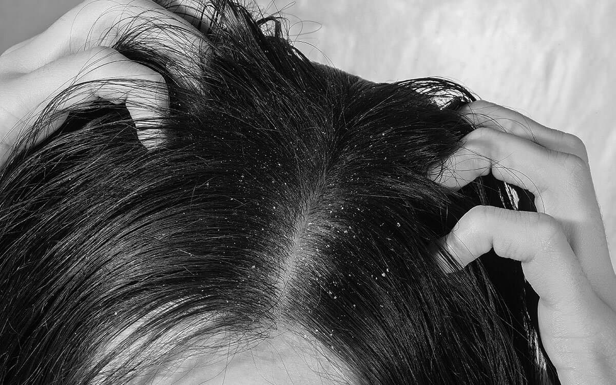 Microbiome Marvels: How Microbes Affect Your Scalp Health