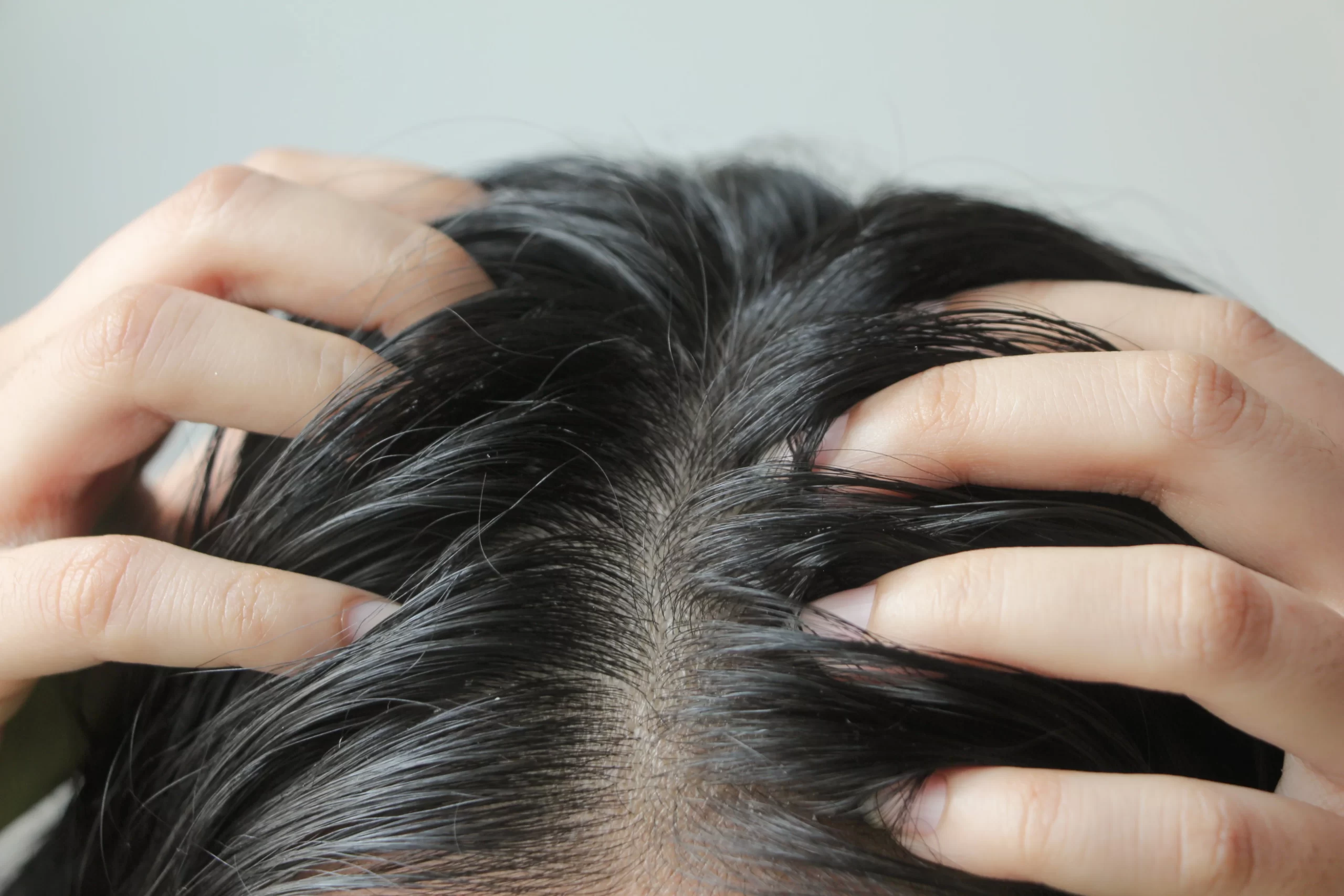 Balancing Act: Mastering the Art of Managing an Oily Scalp with Ease